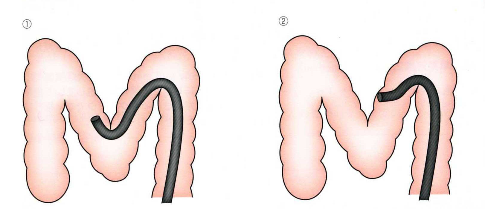 Water Immersion Colonoscopy Technique